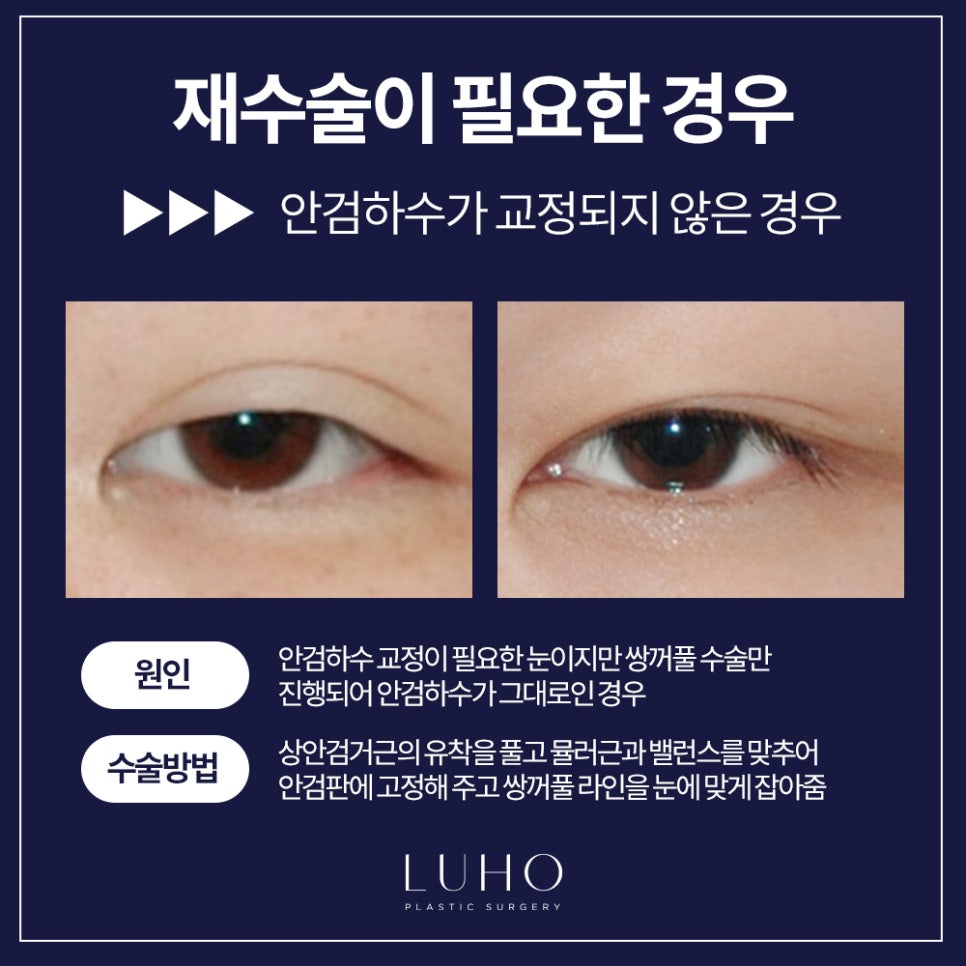 Double Eyelid Revision Surgery — Let’s Finish It at Luho! image 6