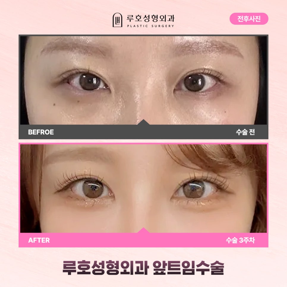 신사역 앞트임수술 경과별 비교하기 관련 이미지 2