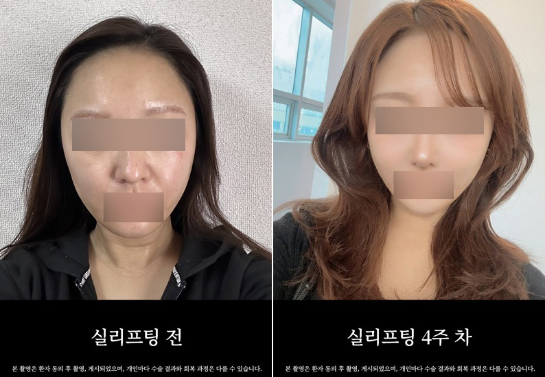 논현역 실리프팅, 나에게 어떤 종류가 맞을지 관련 이미지 6