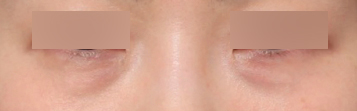 Reduce Deep Dark Circles and Brighten the Eye Area with Under-Eye Fat Repositioning at Sinsa Station image 4