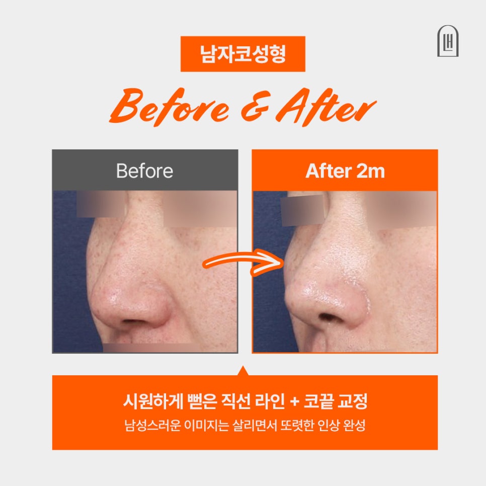 자연스러운 코 개선이 가능한 남자코성형잘하는곳 관련 이미지 1
