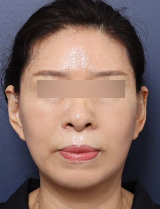 Before and After Reveal of a Refined Jawline at a Place Known for Facelift Surgery Near Sinsa Station image 5