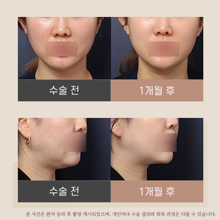 신사역 성형외과 미니거상 전후 비교 후기 관련 이미지 3