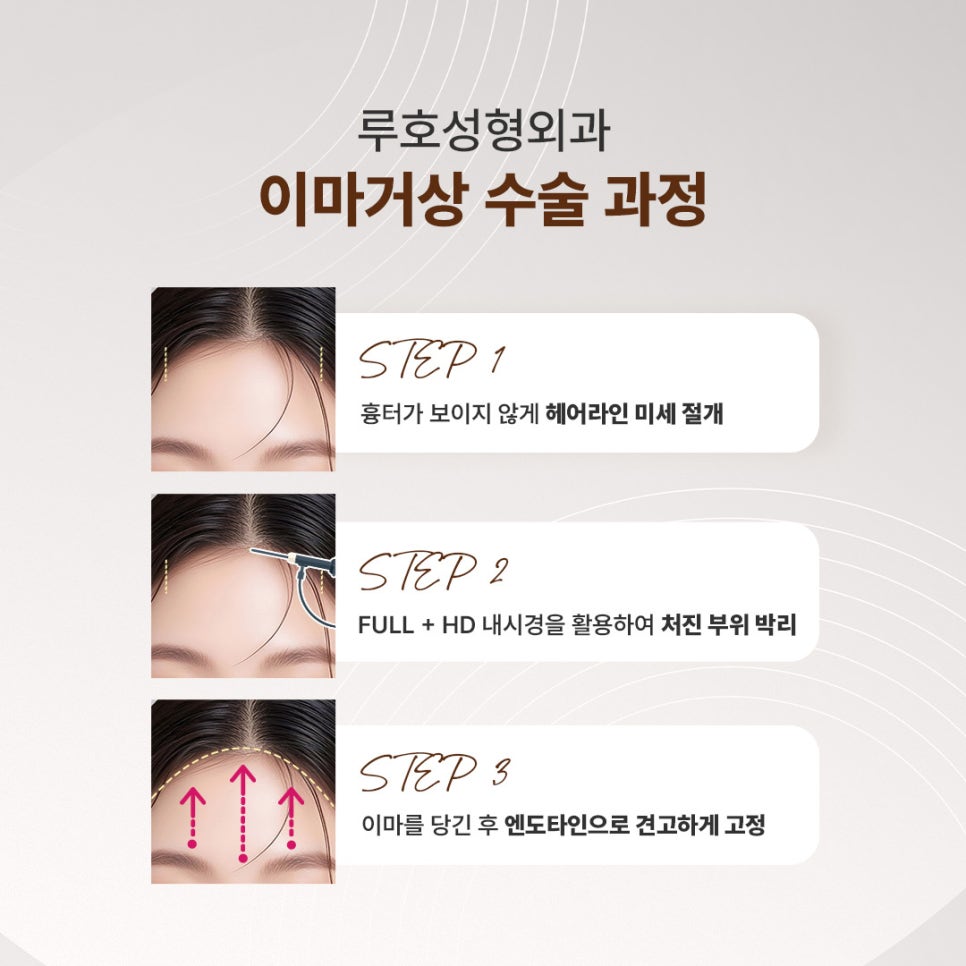 A Review of Forehead Lift Surgery at Sinsa Station That Completed a Natural Youthful Look image 2