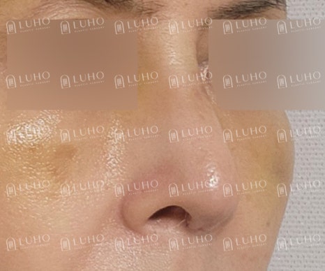 얼굴 균형을 고려해 매부리와 휜코를 교정한 코수술 관련 이미지 5