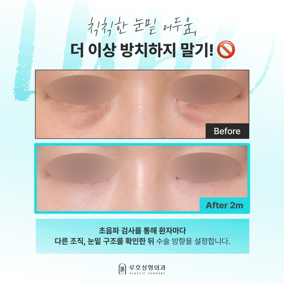 Dark Under-Eye Areas: A Review of Changes with Under-Eye Fat Repositioning at Sinsa Station image 1