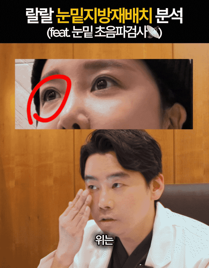 Reduce Deep Dark Circles and Brighten the Eye Area with Under-Eye Fat Repositioning at Sinsa Station image 3
