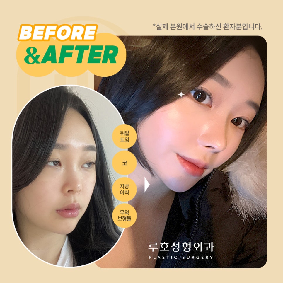 ［루호성형외과］수술 전/후 사진 비교하기 관련 이미지 4