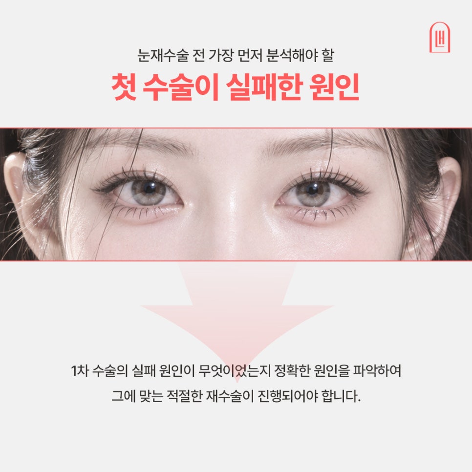 첫 수술보다 까다로웠던 눈재수술 후기 살펴보기 관련 이미지 2