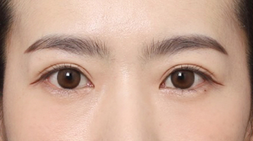 Could a Tired-Looking Appearance Change with a Forehead Lift in Gangnam at Sinsa Station? image 5