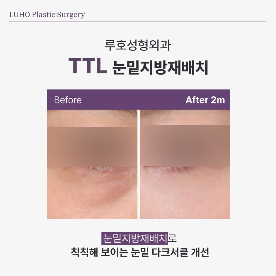 A Review of Under-Eye Surgery Near Sinsa Station That Changed My Shadowed Impression Caused by Dark Circles image 1
