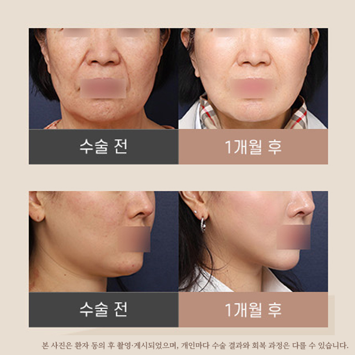 신사역 성형외과 미니거상 전후 비교 후기 관련 이미지 2