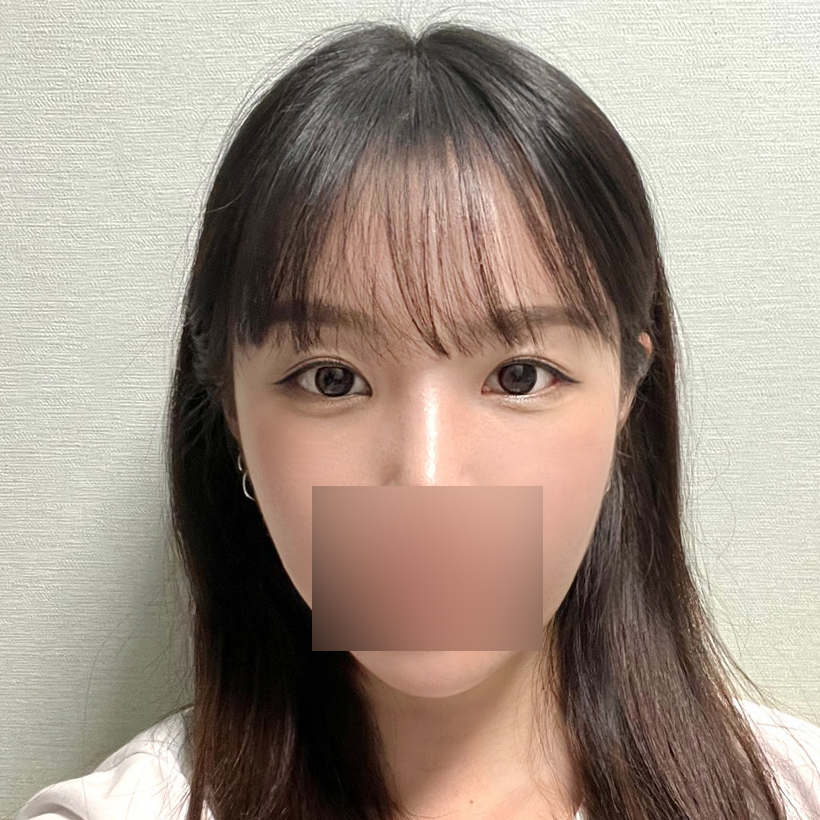 A Review of Shinsegae Station Under-Eye Fat Repositioning to Improve Dark Shadows Under the Eyes image 3