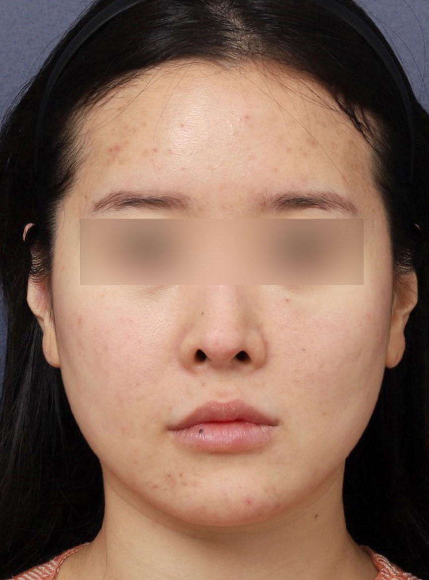 Before and After: Refining a Sagging Lower Face with Thread Lifting at Sinsa Station image 3