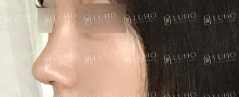 Before and After Gangnam Rhinoplasty for a Hump Nose: Refining the Prominent Hump for a New Look image 10