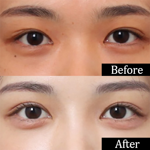 Incisional Double Eyelid Surgery Near Nonhyeon Station: Which Eyes Is It Good For? image 2