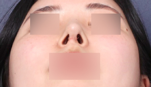 콧구멍 비대칭 교정, 신사역 성형외과 후기 살펴보기 관련 이미지 3