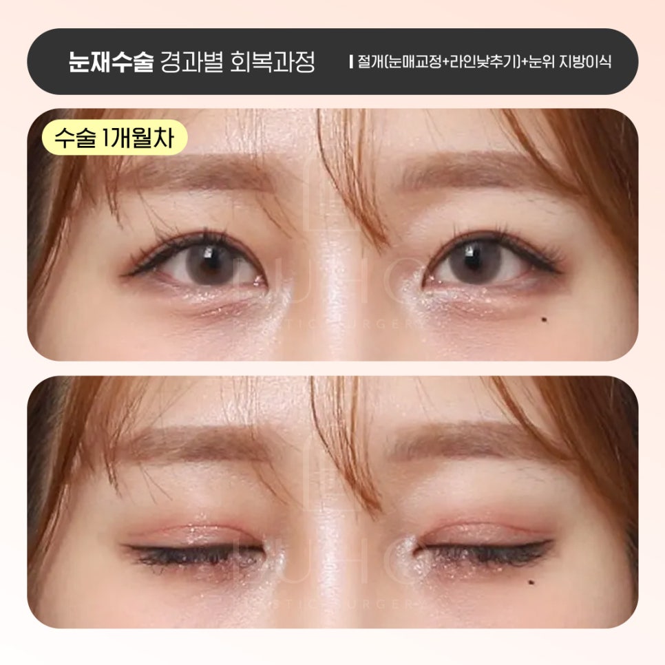 Luho Plastic Surgery Revision Eyelid Surgery Recovery Process by Stage image 4