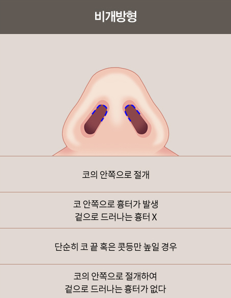 Sinsa Station Nose Plastic Surgery Clinic, Open vs. Closed Nose Surgery image 5
