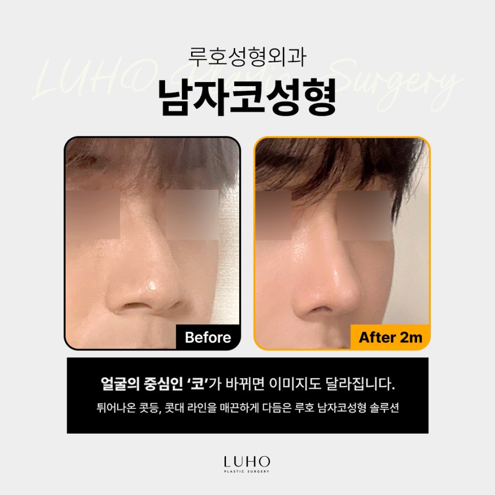남다른 라인을 만들어 낸 신사역남자 코성형 전후 비교 관련 이미지 1