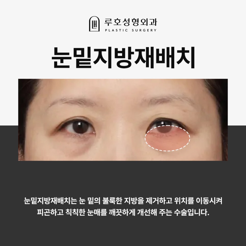 눈밑볼록, 신사역 눈밑지방재배치 받은 후기 관련 이미지 3