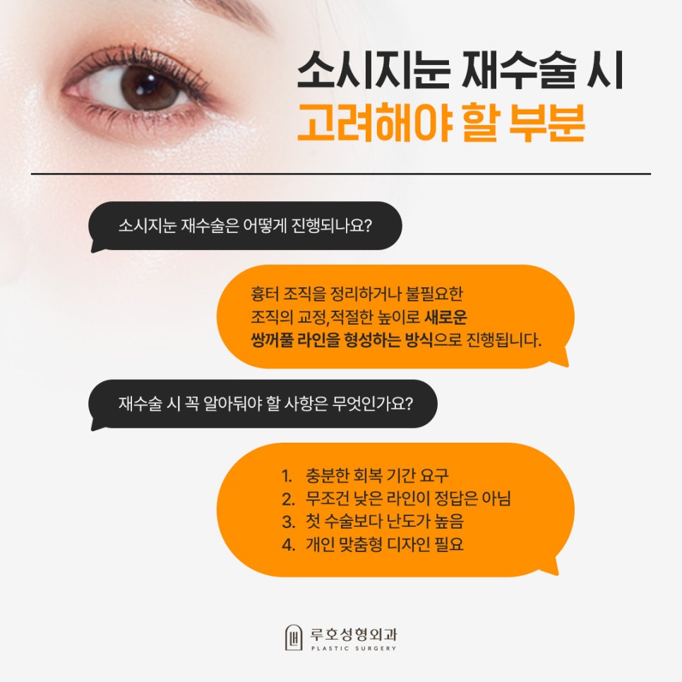 소시지 눈 재수술로 자연스럽고 또렷해진 눈매 관련 이미지 4