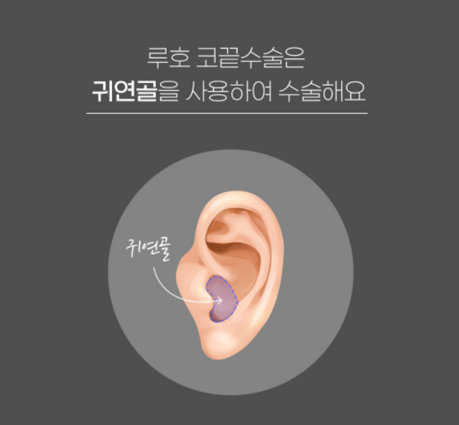 [Luho Plastic Surgery] Luho’s First Nose Surgery image 6