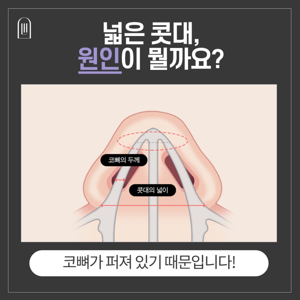 넓은 콧대,이제는 슬림하고 세련되게! 관련 이미지 4