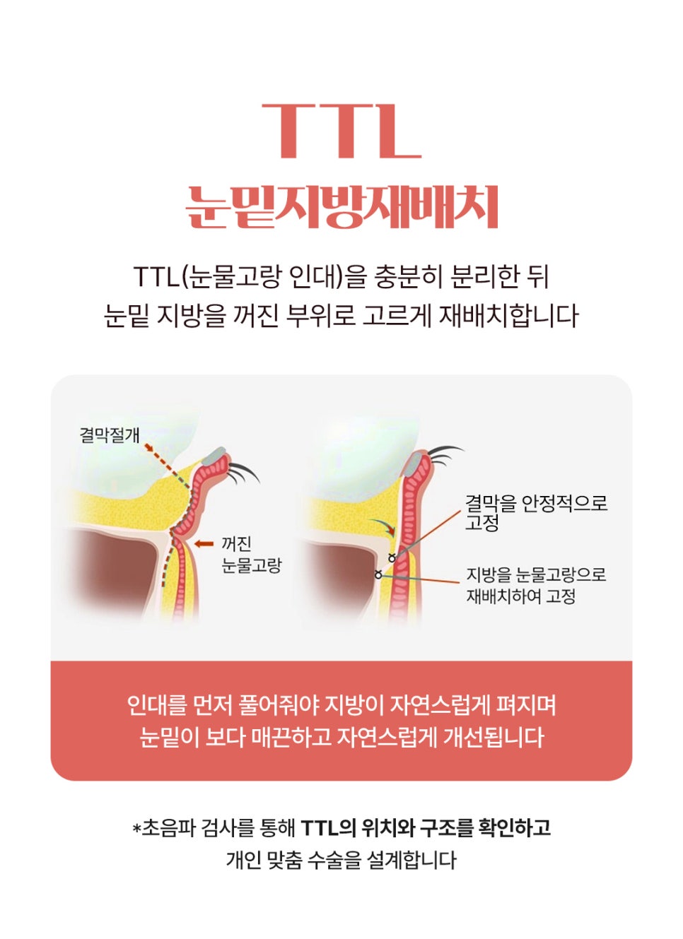 눈밑의 불룩함과 그림자를 완화해준 눈밑지방재배치 효과 관련 이미지 2