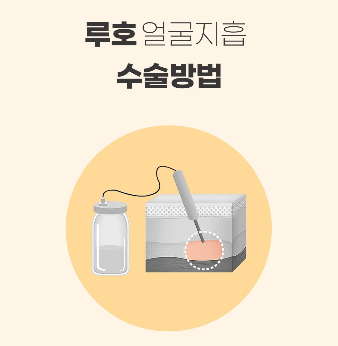 [Luoho Plastic Surgery] Slim V-Line Face Liposuction image 8