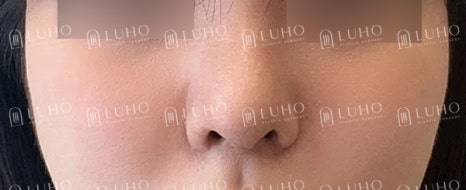 Redesigning a Bulbous Nose After 9 Years: Revision Rhinoplasty image 8