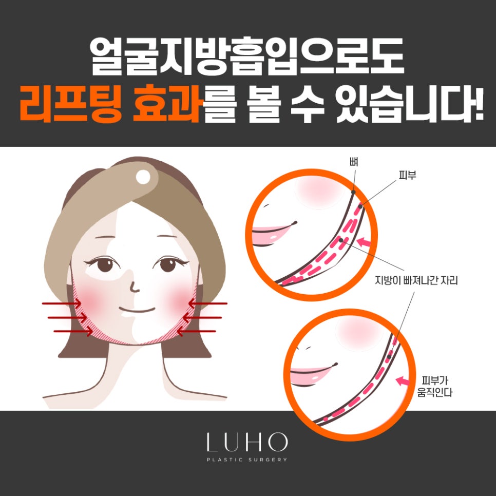 갸름한 얼굴라인, 루호성형외과 얼굴지방흡입 관련 이미지 4