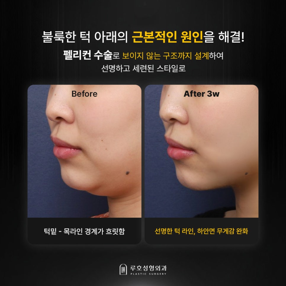 매끄러운 턱라인을 만든 신사역 펠리컨 수술 살펴보기 관련 이미지 1