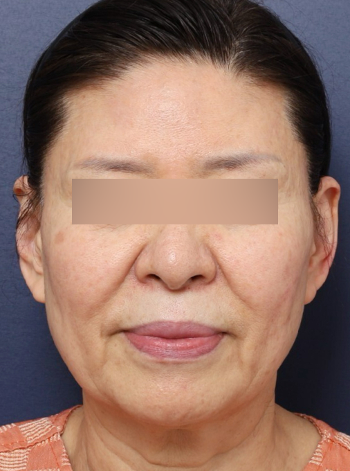 신사역 성형외과, 리얼 안면거상 후기 살펴보기 관련 이미지 2
