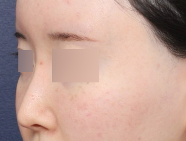 Sinsa Station Nose Revision Surgery, Real Results Correcting a Long Nose image 2