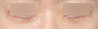 Sinsa Station Under-Eye Fat Repositioning Clinic: Dark Circles + Review of Improvement for Uneven Under-Eyes image 5