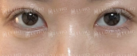 How Revision Eye Surgery Changed Uneven Eyes and a Sleepy-Looking Eye Shape image 4