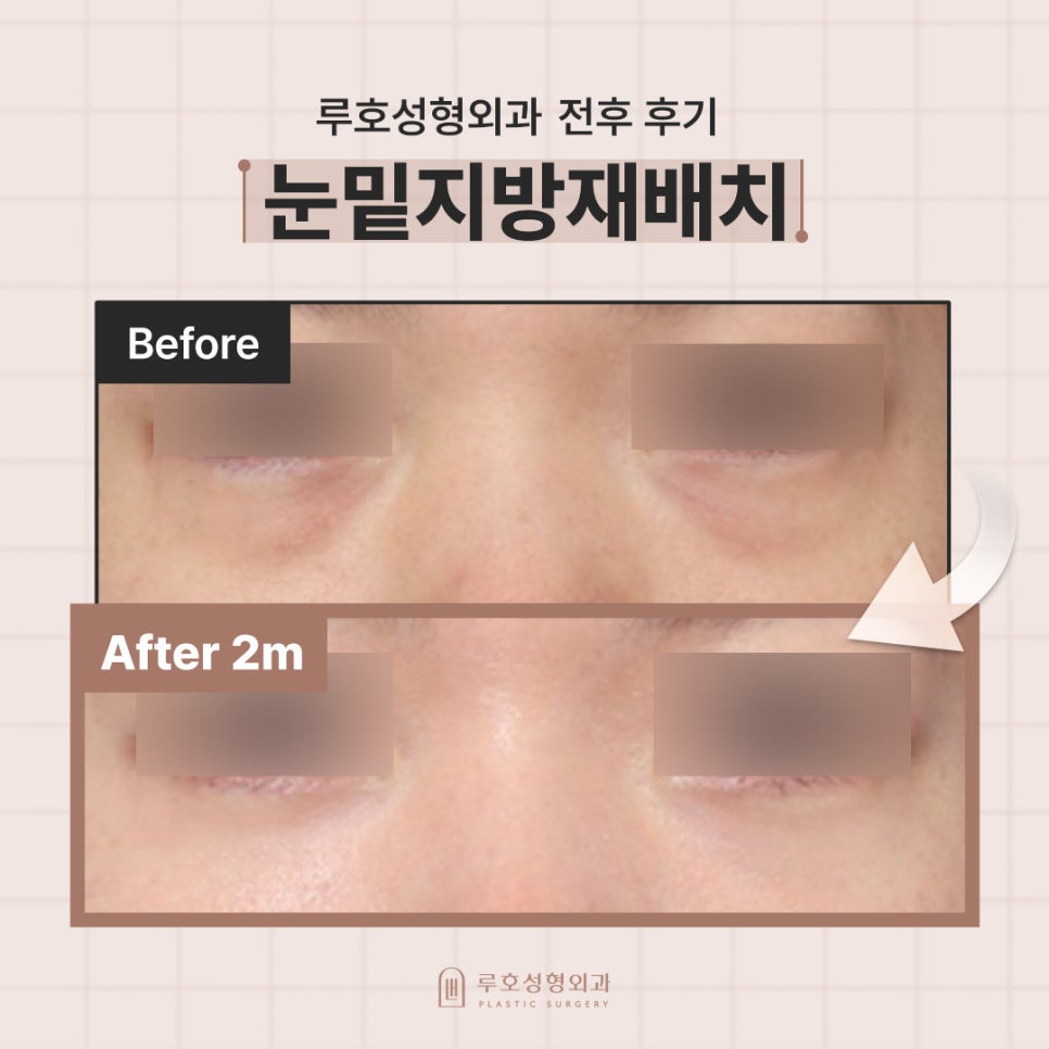 생기 있는 눈매로 환한 인상을 되찾은 신사역 눈밑지 관련 이미지 1