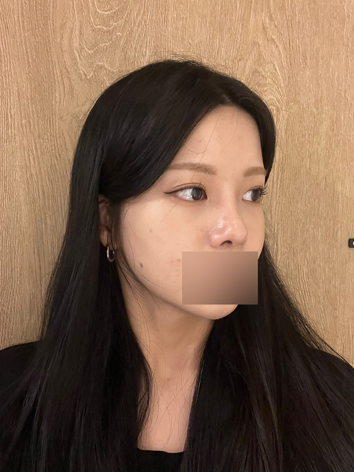 신사 얼굴지방이식 효과, 전후 비교 후기 관련 이미지 3