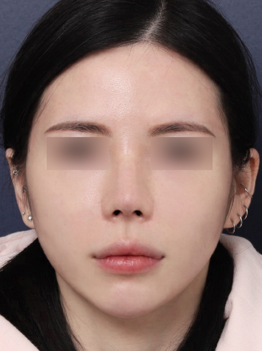 휘어진 코를 바르게 신사역 휜코수술 후기 관련 이미지 6