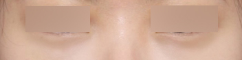 How to Get Rid of Dark Circles: A Look at Under-Eye Fat Repositioning Reviews Near Sinsa Station image 10