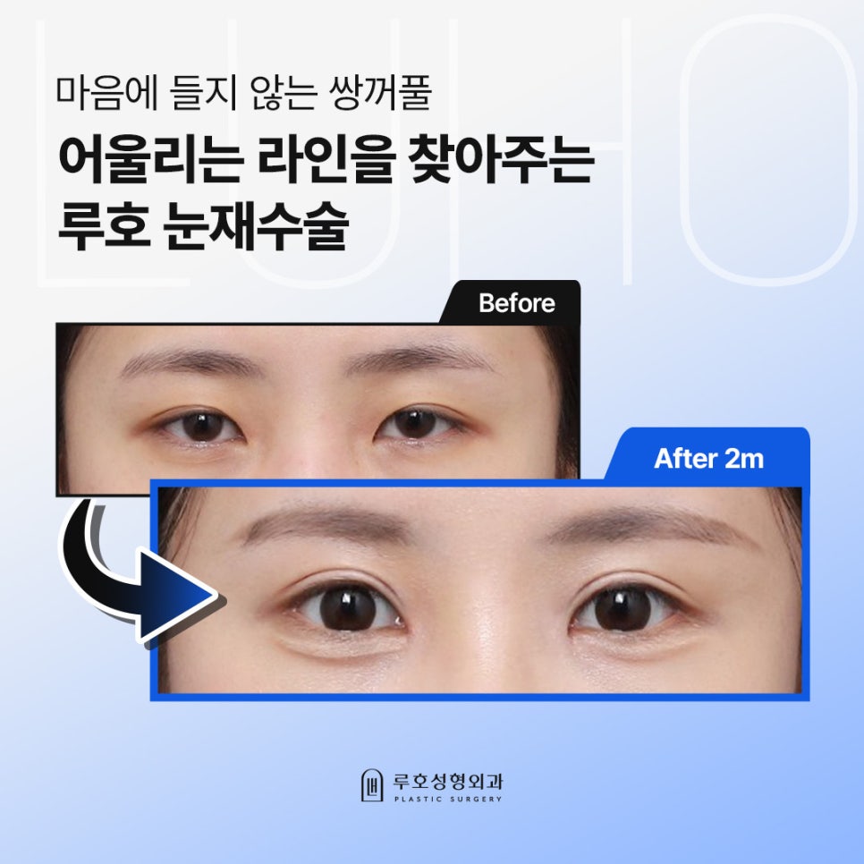 내 눈에 맞는 디자인 설계를 거친 눈재수술 후기 관련 이미지 1