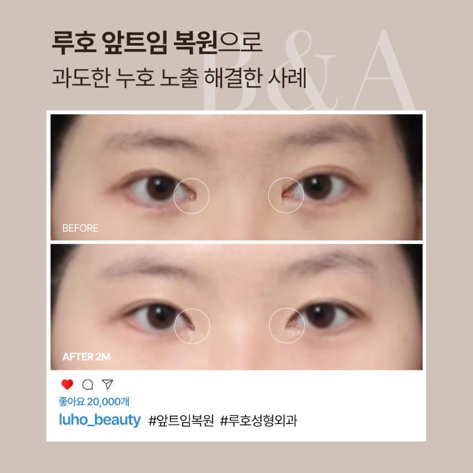 Review of Medial Canthoplasty Revision at Sinsa Station That Resolved Excessive Lacrimal Caruncle Exposure image 1