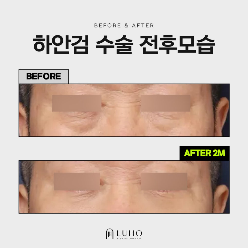 Curious About a Real Case of Lower Blepharoplasty for Under-Eye Sagging at Sinsa Station? image 1