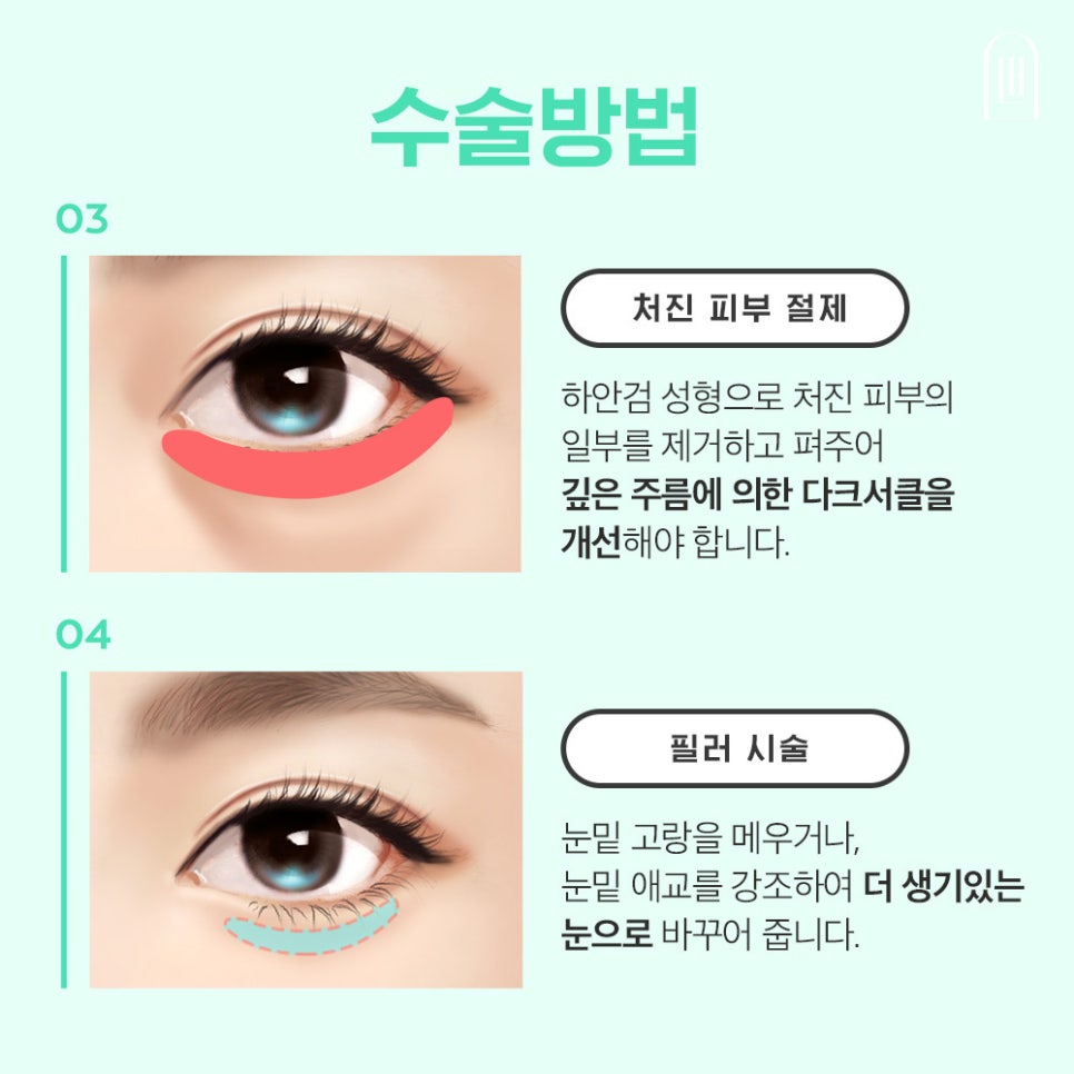 눈밑지방재배치로 환해지고 밝아진 얼굴로 관련 이미지 5