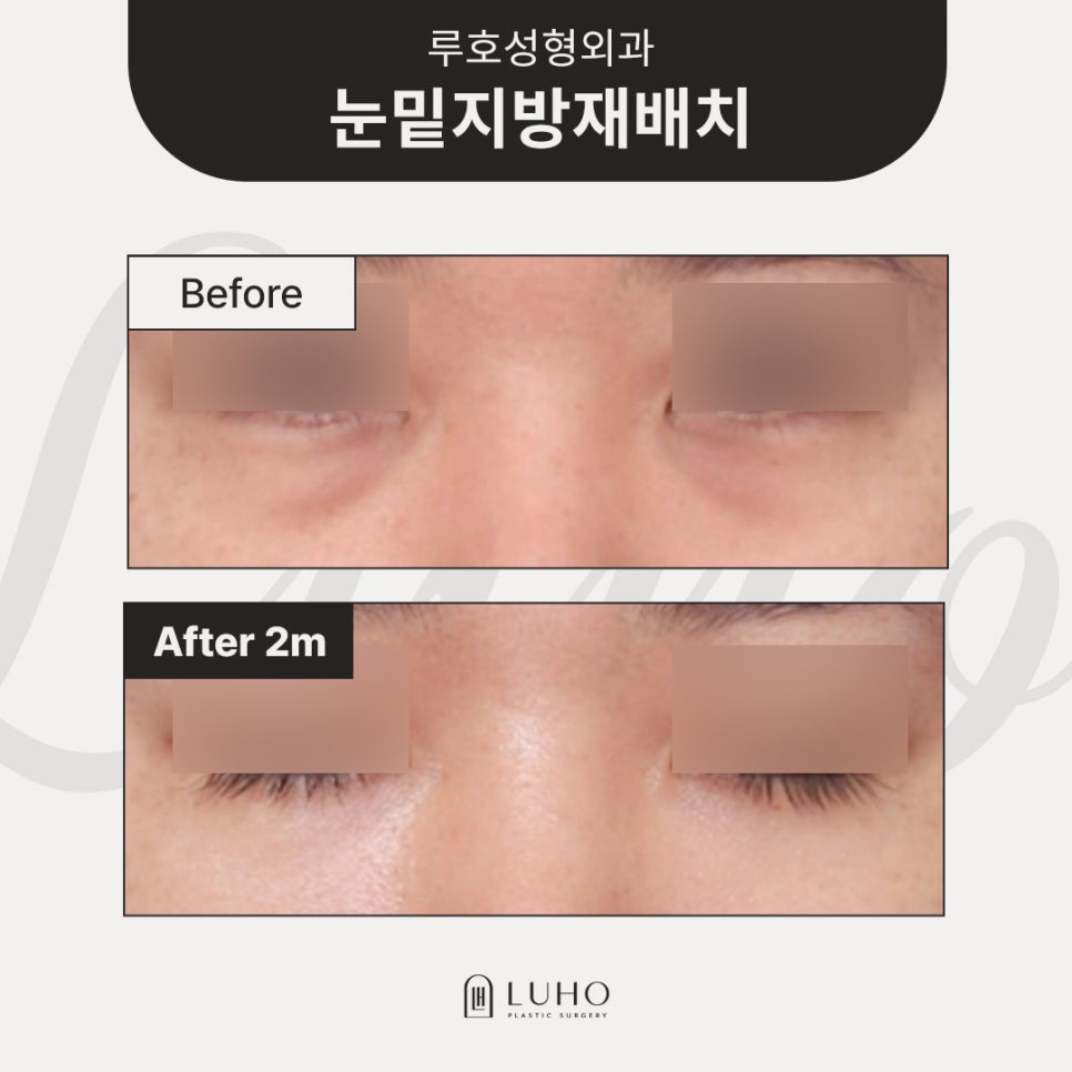 Review of Improvement to a Smooth Under-Eye Area at a Sinsa Station Under-Eye Surgery Clinic image 1
