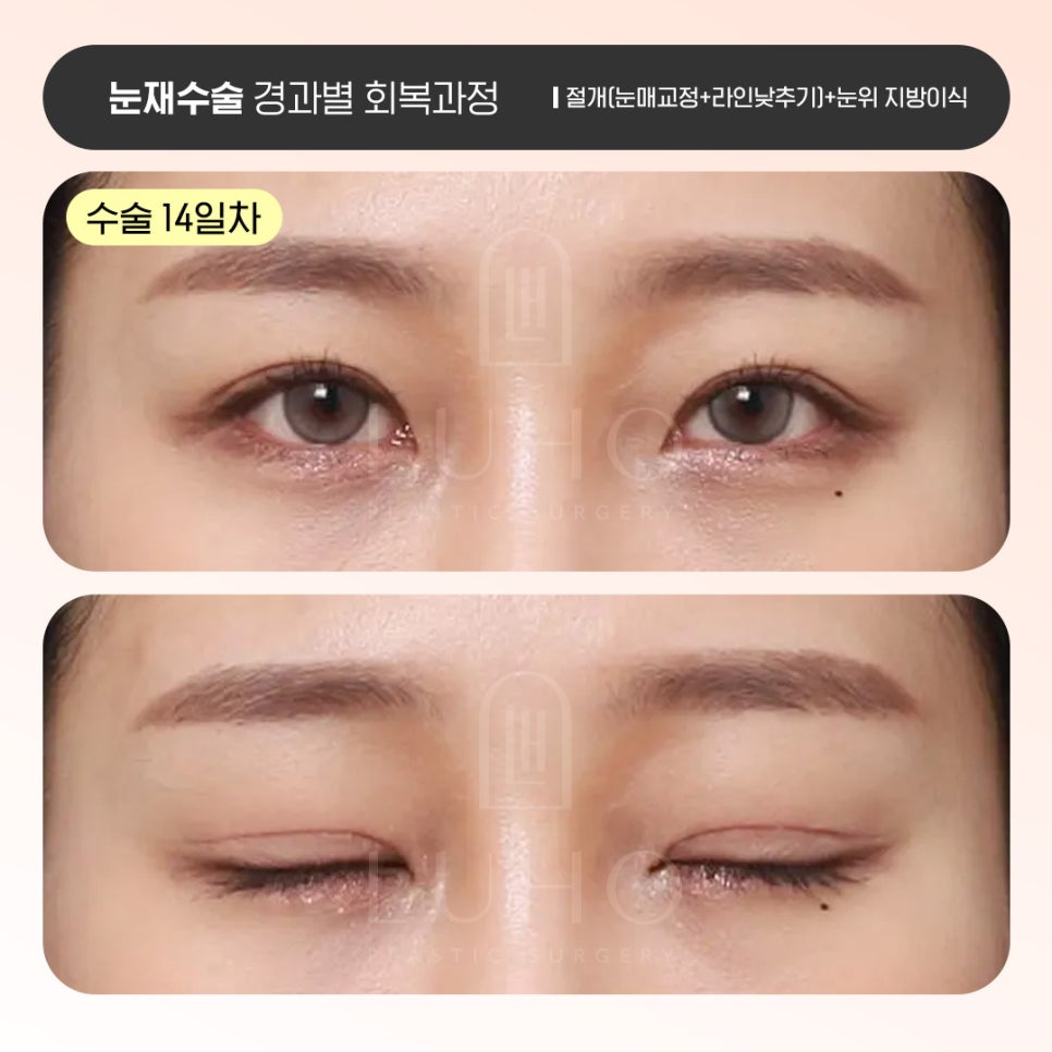 Luho Plastic Surgery Revision Eyelid Surgery Recovery Process by Stage image 3