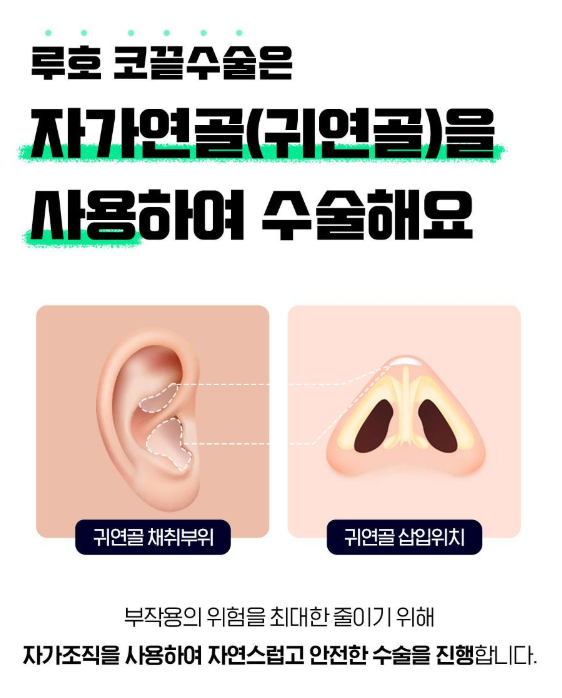 A Rhinoplasty Review for the Nasal Tip at Sinsa Station That Changed a Blurry Impression image 5