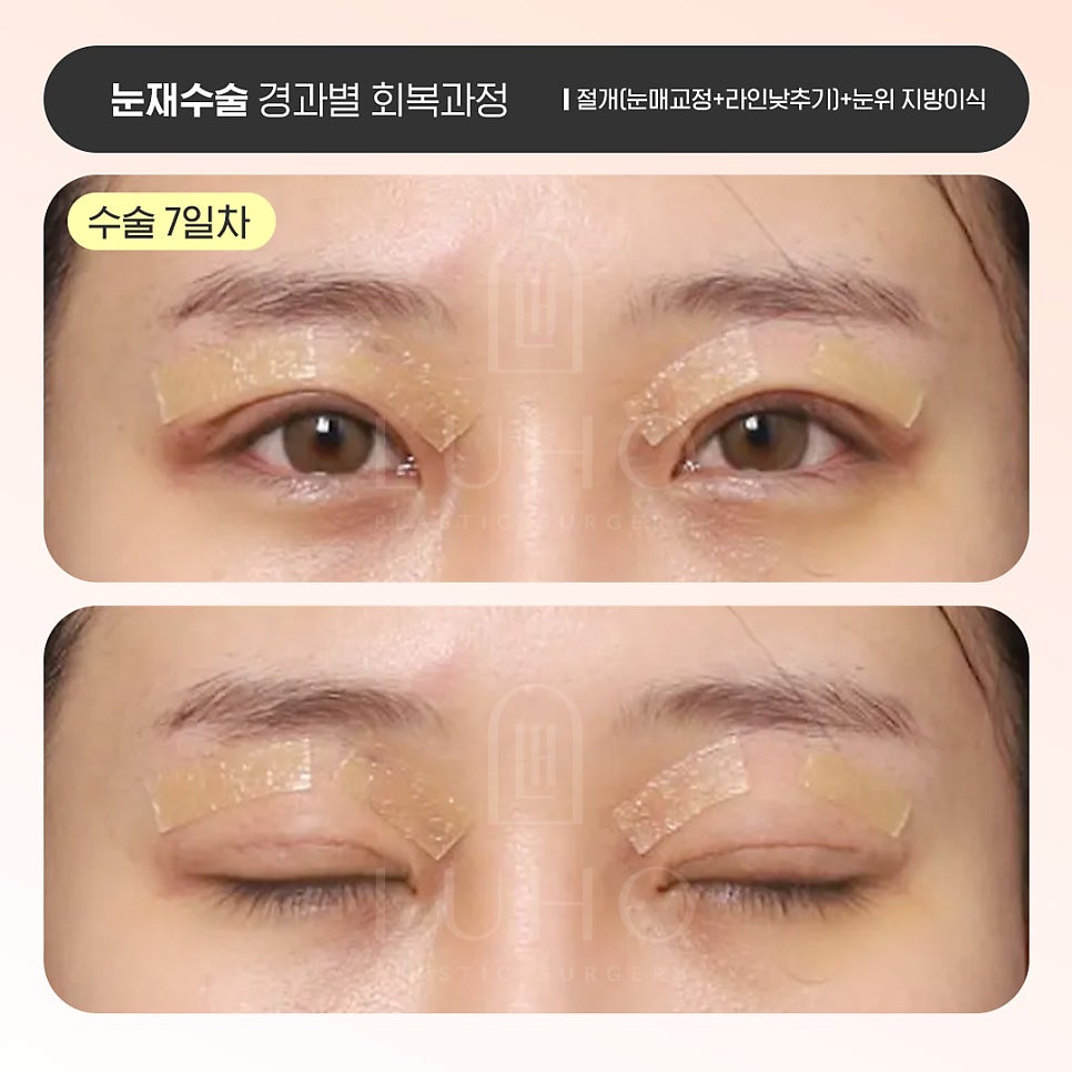 Luho Plastic Surgery Revision Eyelid Surgery Recovery Process by Stage image 2