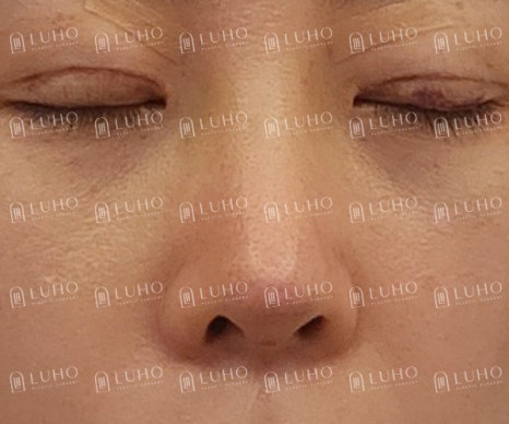 A Review of Eye & Nose Revision Surgery That Addressed the Shortcomings of Previous Surgery image 7